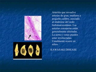 Arteritis que envuelve arterias de gran, mediano y pequeño calibre, asociado al síndrome del nodo linfomucocutáneo. Las asterias coronarias están generalmente afectadas. La aorta y venas pueden estar involucradas.  Usualmente ocurre en niños.  KAWASAKI DISEASE                                                         