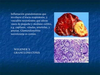 WEGENER´S GRANULOMATOSIS                                Inflamación granulomatosa que involucra el tracto respiratorio, y vasculitis necrotizante que afecta vasos de pequeño y mediano calibre, e.g. capilares, vénulas, arteriolas, y arterias. Glomerulonefritis necrotizante es común.         
