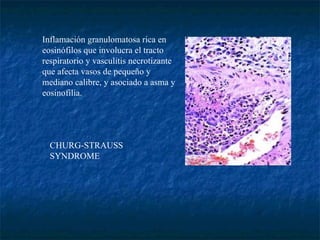 CHURG-STRAUSS SYNDROME                           Inflamación granulomatosa rica en eosinófilos que involucra el tracto respiratorio y vasculitis necrotizante que afecta vasos de pequeño y mediano calibre, y asociado a asma y eosinofilia.         