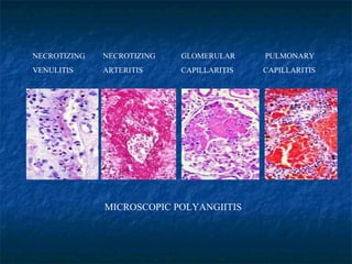 MICROSCOPIC POLYANGIITIS NECROTIZING NECROTIZING   GLOMERULAR   PULMONARY VENULITIS ARTERITIS   CAPILLARITIS   CAPILLARITIS 