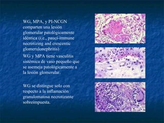                       WG se distingue solo con respecto a la inflamación granulomatosa necrotizante sobreimpuesta.                        WG y MPA tiene vasculitis sistémica de vaso pequeño que se asemeja patológicamente a la lesión glomerular.                        WG, MPA, y PI-NCGN comparten una lesión glomerular patológicamente idéntica (i.e., pauci-immune necrotizing and crescentic glomerulonephritis)  