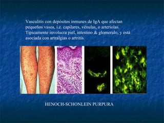 HENOCH-SCHONLEIN PURPURA                                                                        Vasculitis con depósitos inmunes de IgA que afectan pequeños vasos, i.e. capilares, vénulas, o arteriolas. Tipicamente involucra piel, intestino & glomerulo, y está asociada con artralgias o artritis.  