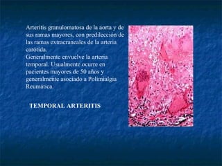TEMPORAL ARTERITIS                         Arteritis granulomatosa de la aorta y de sus ramas mayores, con predilección de las ramas extracraneales de la arteria carótida. Generalmente envuelve la arteria temporal.   Usualmente ocurre en pacientes mayores de 50 años y generalmente asociado a Polimialgia Reumática. 