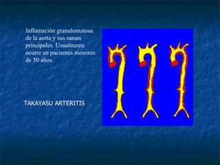 TAKAYASU ARTERITIS                                                      Inflamación granulomatosa de la aorta y sus ramas principales. Usualmente ocurre en pacientes menores de 50 años. 