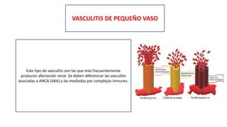 VASCULITIS DE PEQUEÑO VASO
Este tipo de vasculitis son las que más frecuentemente
producen afectación renal. Se deben diferenciar las vasculitis
asociadas a ANCA (VAA) y las mediadas por complejos inmunes.
 