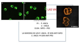 ESPECTRO CLINICO DE LAS VASCULITIS
IFI : P- ANCA
C – ANCA
ELISA : MPO – PR3
LA MAYORIA DE LOS P- ANCA - SON ANTI MPO
C- ANCA  SON ANTI PR3
 