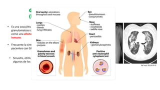 Granulomatosis con poliangeítis
(Enfermedad de Wegener) (GPA)
• Es una vasculitis que típicamente produce inflamación
granulomatosa del tracto respiratorio superior e inferior, así
como una afectación glomerular necrotizante pauci-
inmune.
• Frecuente la sintomatología de oído, nariz y garganta en los
pacientes con GPA que en la PAM (90 % vs 35 %)
• Sinusitis, otitis media, rinorrea o pérdida de audición son
algunos de los síntomas descritos en estos pacientes.
 