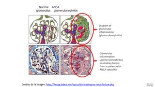 Normal ANCA
glomerulus glomerulonephritis
Diagram of
glomerular
inflammation
(glomerulonephritis)
Glomerular
inflammation
(glomerulonephritis)
in a kidney biopsy
from a patient with
ANCA vasculitis
Credito de la imagen: http://ifesyg.lebest.my/vasculitis-leading-to-renal-failure.php Dra. Rivero
CRAIC Mty
 