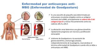 Enfermedad por anticuerpos anti-
MBG (Enfermedad de Goodpasture)
 Es una vasculitis de pequeño vaso determinada por
anticuerpos circulantes dirigidos contra un antígeno
intrínseco de la MBG, principalmente la cadena alfa-3 del
colágeno tipo IV y menos frecuentemente contra las
cadenas alfa-4 y alfa-5
 La afectación renal determina una glomerulonefritis
rápidamente progresiva con necrosis y proliferación
extracapilar
 síndrome de Goodpasture a la asociación de
glomerulonefritis y hemorragia alveolar,
independientemente de la patogenia, reservándose el
término enfermedad de Goodpasture cuando ello se debe a
anticuerpos anti-MBG.
 
