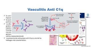  Es una infrecuente vasculitis asociada con urticaria e
hipocomplementemia.
 Se pueden observar manifestaciones articulares,
pulmonares, oculares y renales .
 La afectación renal se caracteriza por hematuria y un
grado variable de proteinuria e insuficiencia renal,
habiéndose descrito muy diferentes patrones
histológicos (glomerulonefritis proliferativa, vasculitis
necrotizante, proliferación extracapilar,
glomerulonefritis membranoproliferativa e incluso
nefritis tubulointersticial).
 La presencia de anticuerpos anti-C1q es uno de los
hallazgos más característicos.
Vasculitis Anti C1q
 