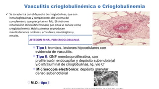 Vasculitis crioglobulinémica o Crioglobulinemia
 Se caracteriza por el depósito de crioglobulinas, que son
inmunoglobulinas y componentes del sistema del
complemento que precipitan en frío. El síndrome
inflamatorio clínico determinado por estas se conoce como
crioglobulinemia. Habitualmente se producen
manifestaciones cutáneas, articulares, neurológicas y
renales.
AFECCION RENAL POR CRIOGLOBULINAS
 