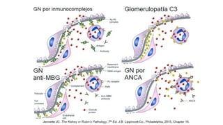 Vasculititis pulmon -riñon