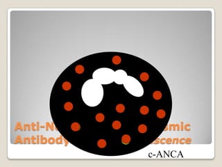 Anti-Neutrophil Cytoplasmic
Antibody Immunofluorescence
c-ANCA
 