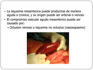 La isquemia mesenterica puede producirse de manera aguda o cronica, y su origen puede ser arterial o venosoEl compromiso vascular agudo mesenterico puede ser causado por:Oclusion venosa o isquemia no oclusiva (vasoespasmo)