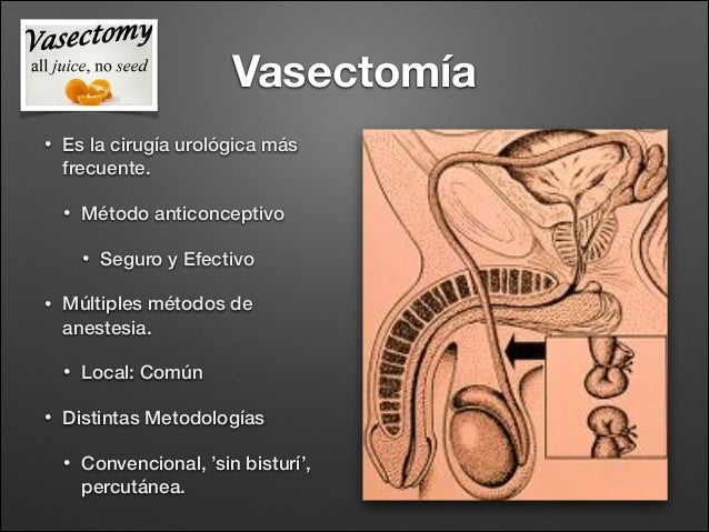 Vasectomía y Circuncision