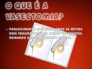 O que é a Vasectomia?Procedimento cirúrgico, onde se retira dois fragmentos dos canais deferentes. Deixando assim o paciente estéril.Procedimento 