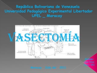 República Bolivariana de Venezuela  Universidad Pedagógico Experimental Libertador UPEL _ Maracay   Vasectomía  Alumno: Luis Díaz Secc: 051 Maracay   Julio del   2011 