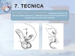 7. TECNICA7. TECNICA
SEPARACIÓN DEL C. DEFERENTESEPARACIÓN DEL C. DEFERENTE. Mediante la técnica de
los tres dedos separa ...