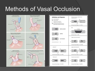 Methods of Vasal Occlusion
 