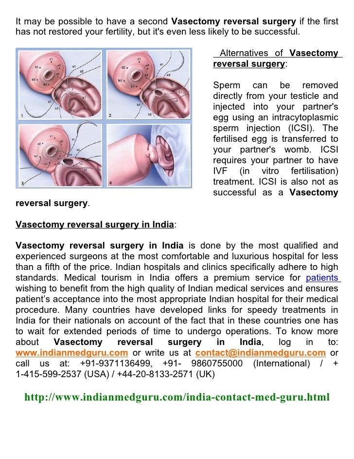 Vasectomy reversal surgery in India Get it