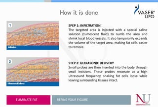 How it is done
SPEP 1: INFILTRATION
The targeted area is injected with a special saline
solution (tumescent fluid) to numb the area and
shrink local blood vessels. It also temporarily expands
the volume of the target area, making fat cells easier
to remove.
STEP 2: ULTRASONIC DELIVERY
Small probes are then inserted into the body through
small incisions. These probes resonate at a high
ultrasound frequency, shaking fat cells loose while
leaving surrounding tissues intact.
REFINE YOUR FIGUREELIMINATE FAT
 