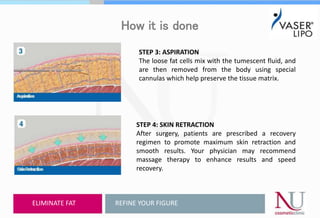 How it is done
STEP 3: ASPIRATION
The loose fat cells mix with the tumescent fluid, and
are then removed from the body using special
cannulas which help preserve the tissue matrix.
STEP 4: SKIN RETRACTION
After surgery, patients are prescribed a recovery
regimen to promote maximum skin retraction and
smooth results. Your physician may recommend
massage therapy to enhance results and speed
recovery.
REFINE YOUR FIGUREELIMINATE FAT
 