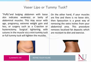Vaser Lipo or Tummy Tuck?
"Puffy"and bulging abdomen with loose
skin indicates weakness or laxity of
abdominal muscles. This may occur with
age, pregnancy, extreme weight gain and
loss, or surgery such as a C-section or
hysterectomy. Surgical tightening with
sutures in the muscle via a mini-tummy tuck
or full tummy tuck will tighten the muscles.
REFINE YOUR FIGUREELIMINATE FAT
On the other hand, if your muscles
are fine and there is no loose skin,
then liposuction is a great way of
removing the extra inches from your
abdominal area. This procedure
removes localized fat deposits which
are resistant to diet and exercise.
 