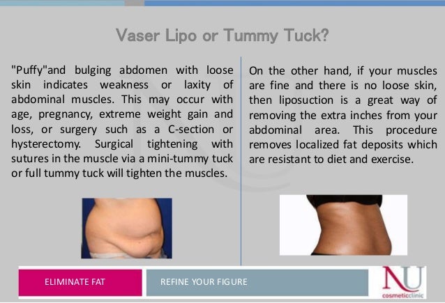 day by day tummy tuck recovery timeline day by day tummy tuck recovery timeline