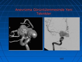 105
İİNTRAKRANYALNTRAKRANYAL AANEVRİZMALARINNEVRİZMALARIN PPATOGENEZİATOGENEZİ
Anevrizma Görüntülenmesinde YeniAnevrizma Görüntülenmesinde Yeni
TekniklerTeknikler
 