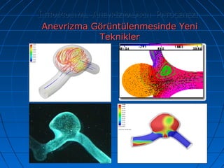 118
İİNTRAKRANYALNTRAKRANYAL AANEVRİZMALARINNEVRİZMALARIN PPATOGENEZİATOGENEZİ
Anevrizma Görüntülenmesinde YeniAnevrizma Görüntülenmesinde Yeni
TekniklerTeknikler
 