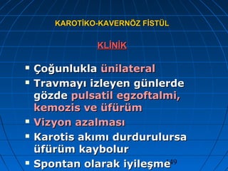 149
KAROTİKO-KAVERNÖZ FİSTÜLKAROTİKO-KAVERNÖZ FİSTÜL
KLİNİKKLİNİK
 ÇoğunluklaÇoğunlukla ünilateralünilateral
 Travmayı izleyen günlerdeTravmayı izleyen günlerde
gözdegözde pulsatil egzoftalmi,pulsatil egzoftalmi,
kemozis ve üfürümkemozis ve üfürüm
 Vizyon azalmasıVizyon azalması
 Karotis akımı durdurulursaKarotis akımı durdurulursa
üfürüm kaybolurüfürüm kaybolur
 Spontan olarak iyileşmeSpontan olarak iyileşme
 