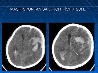 22
MASİF SPONTAN SAK + ICH + İVH + SDH…MASİF SPONTAN SAK + ICH + İVH + SDH…
 