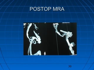30
POSTOP MRAPOSTOP MRA
 