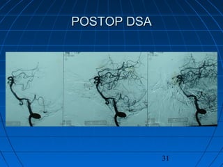 31
POSTOP DSAPOSTOP DSA
 