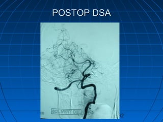 32
POSTOP DSAPOSTOP DSA
 