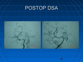 43
POSTOP DSAPOSTOP DSA
 