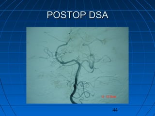 44
POSTOP DSAPOSTOP DSA
 