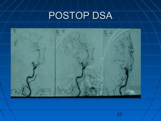 55
POSTOP DSAPOSTOP DSA
 