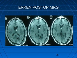 78
ERKEN POSTOP MRGERKEN POSTOP MRG
 