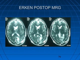 79
ERKEN POSTOP MRGERKEN POSTOP MRG
 
