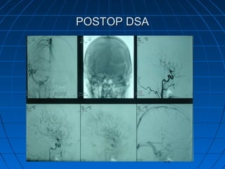 80
POSTOP DSAPOSTOP DSA
 