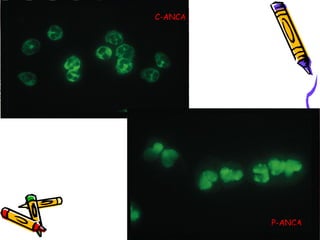 C-ANCA




         P-ANCA
             21
 