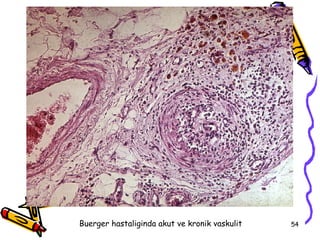 Buerger hastaliginda akut ve kronik vaskulit   54
 