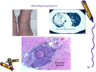 Mikroskopik polianjiitis




                           58
 