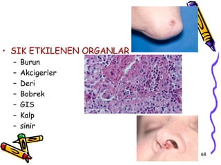 • SIK ETKILENEN ORGANLAR
  –   Burun
  –   Akcigerler
  –   Deri
  –   Bobrek
  –   GIS
  –   Kalp
  –   sinir


                           68
 