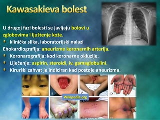 U drugoj fazi bolesti se javljaju bolovi u
zglobovima i ljuštenje kože.
klinička slika, laboratorijski nalazi
Ehokardiografija: aneurizme koronarnih arterija.
Koronarografija: kod koronarne okluzije.
Liječenje: aspirin, steroidi, iv. gamaglobulini.
Kirurški zahvat je indiciran kad postoje aneurizme.
Wikipedia.org
 