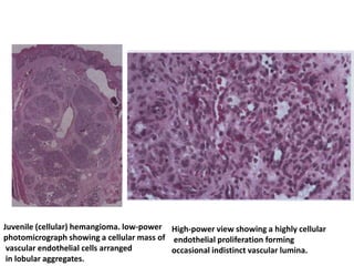 Juvenile (cellular) hemangioma. low-power
photomicrograph showing a cellular mass of
vascular endothelial cells arranged
in lobular aggregates.
High-power view showing a highly cellular
endothelial proliferation forming
occasional indistinct vascular lumina.
 