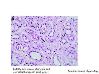 Endothelium becomes flattened and
resembles that seen in adult forms American journal of pathology
 