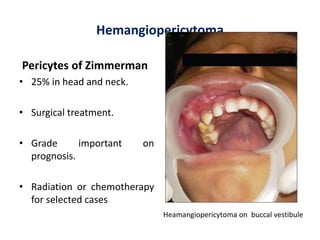 Hemangiopericytoma
Pericytes of Zimmerman
• 25% in head and neck.
• Surgical treatment.
• Grade important on
prognosis.
• Radiation or chemotherapy
for selected cases
Heamangiopericytoma on buccal vestibule
 