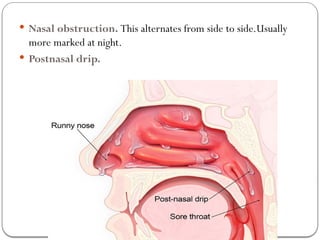 VASOMOTOR AND ALLERGIC RHINITS presentation | PPTX